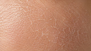 Type de peau sèche